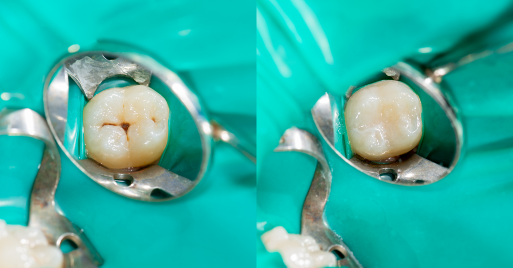 أنواع حشو الأسنان